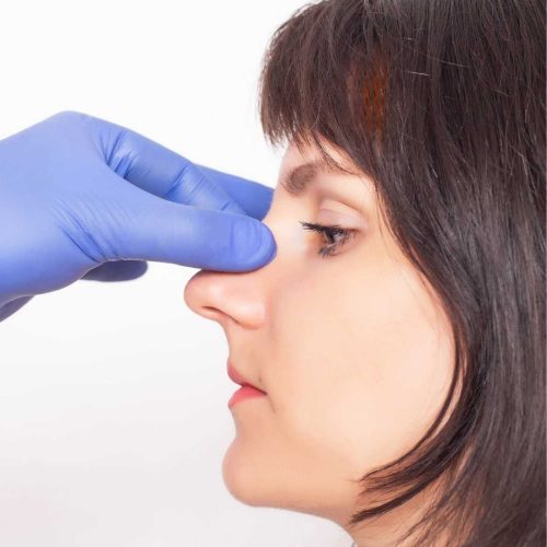 Rinomodelación nariz grande en la clínica de medicina estética en Madrid IME