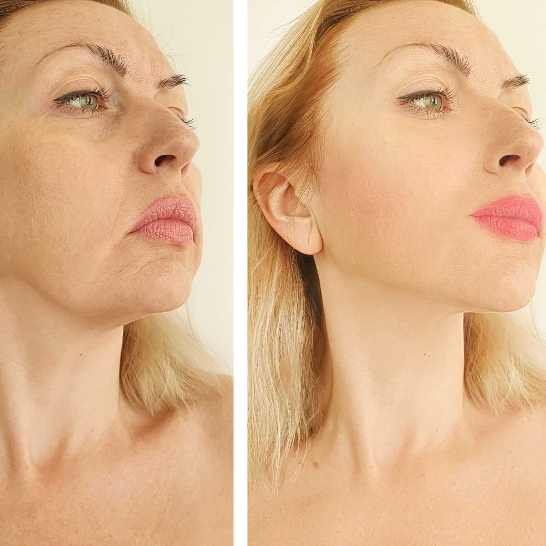 Antes y Después Marcación mandibular con ácido hialurónico en la clínica de medicina estética IME - Instituto de medicina estética