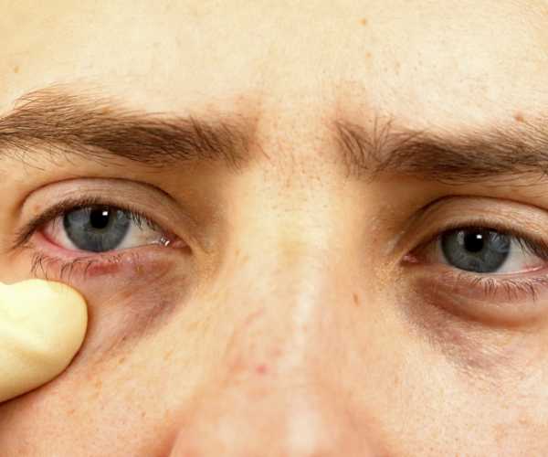 eliminar ojeras hombre en la clínica de medicina estética IME, Instituto de Medicina Estética en Madrid