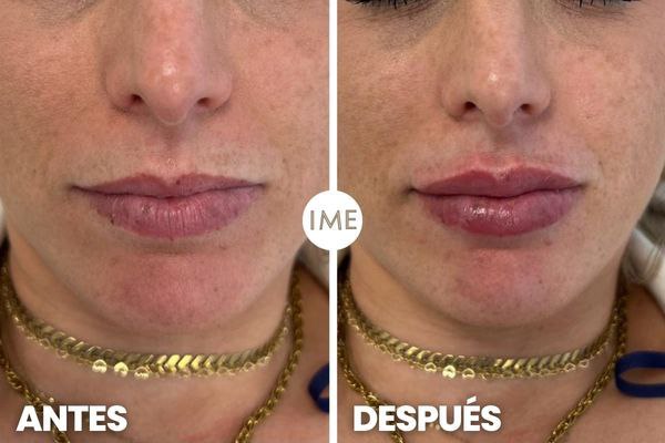 Antes y Después del tratamiento de aumento de Labios