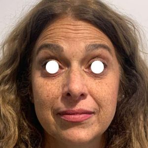 Botox Arrugas frente. El antes