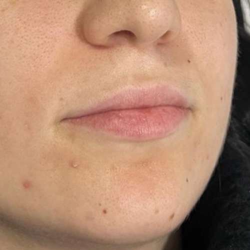 Ácido hialurónico en el aumento de labios antes