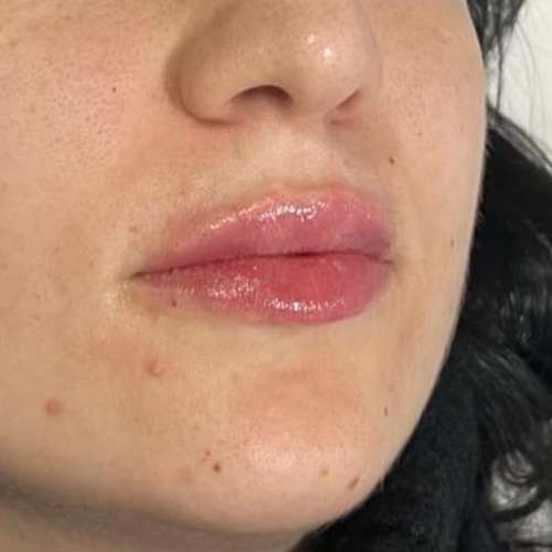 Ácido hialurónico en el aumento de labios despues