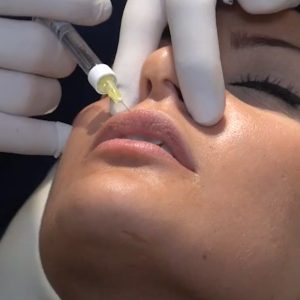 Relleno de Labios tratamiento paciente IME
