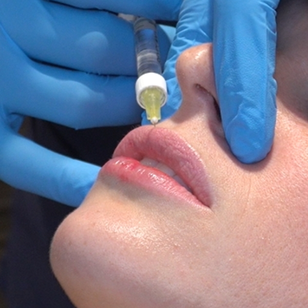 Aumento de Labios tratamiento paciente IME