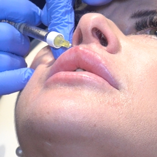 Incremento de Labios tratamiento paciente IME