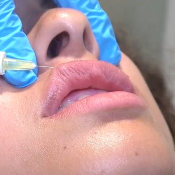 Aumento de Labios tratamiento paciente IME