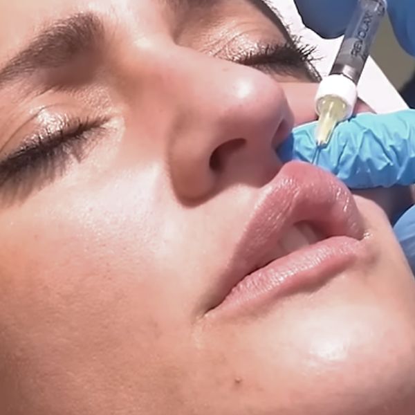 aumento de labios con acido hialuronico en Clinica IME. Paciente Instituto Medicina Estetica aumento de labios con acido hialuronico en Clinica IME. Paciente Instituto Medicina Estetica