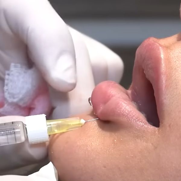 Aumento e hidratación de labios. Paciente de la Clínica IME Aumento e hidratación de labios. Paciente de la Clínica IME