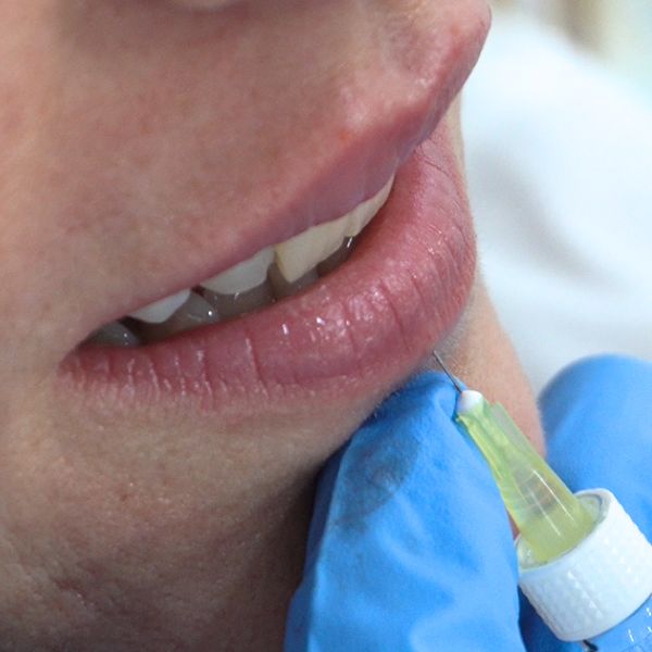 Hidratación y perfilado de labios. Paciente de la Clínica IME Hidratación y perfilado de labios. Paciente de la Clínica IME