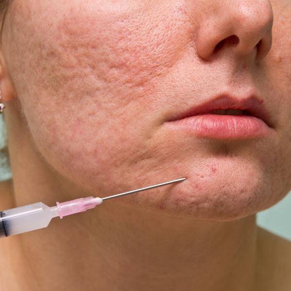 Enzimas recombinantes para cicatrices en la clinica de medicina estetica IME Enzimas recombinantes para cicatrices en la clinica de medicina estetica IME