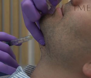 Enzimas Recombinantes en Papada. Paciente de la Clinica de Medicina Estética IME