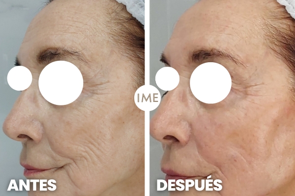 Inductores de Colágeno Antes y Después en Clínica Medicina Estética IME Inductores de Colágeno Antes y Después en Clínica Medicina Estética IME