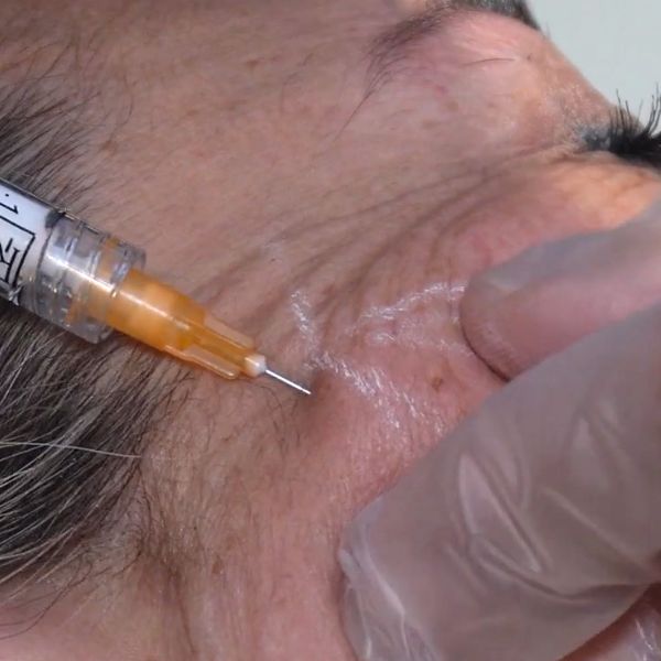 Sculptra tratamiento-estimulador de colágeno en Madrid. Paciente Clínica IME Sculptra tratamiento-estimulador de colágeno en Madrid. Paciente Clínica IME